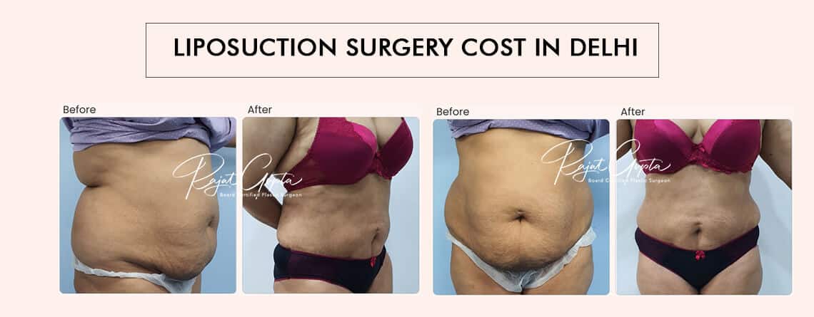 Liposuction Surgery Cost in Delhi