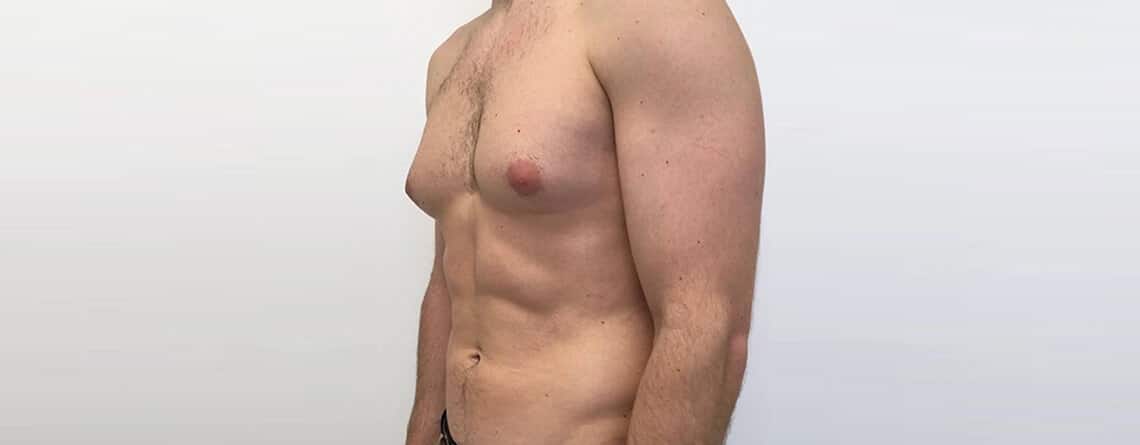 Gynecomastia Surgery