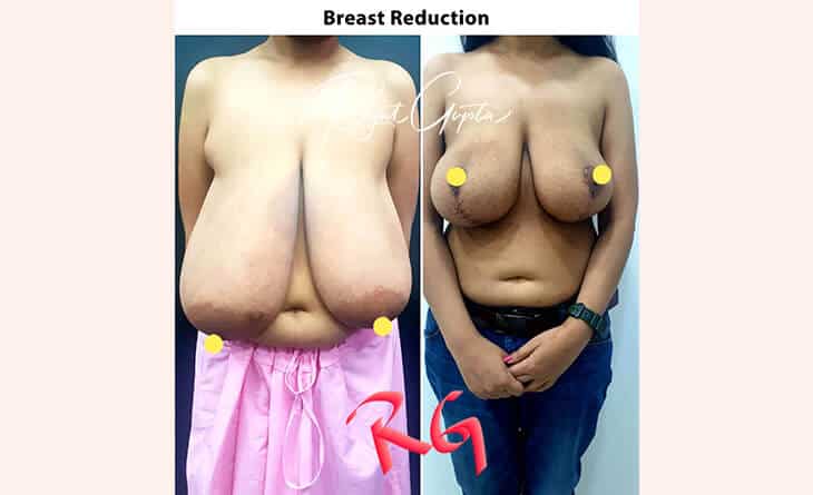 breast reduction surgery before and after