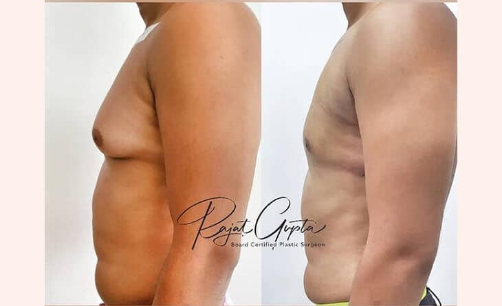 Gynecomastia Surgery cost in Delhi