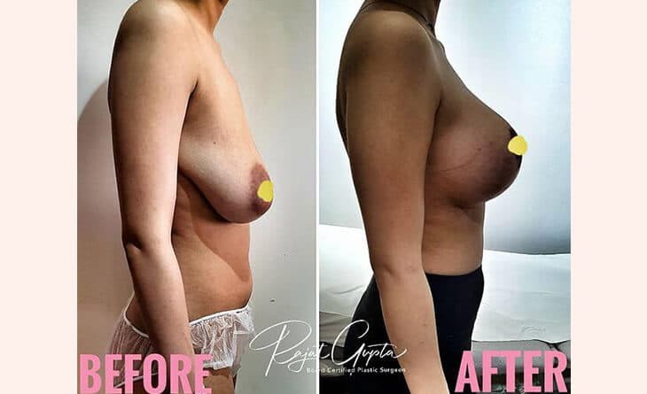 Breast Lift Surgery before and after
