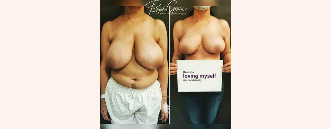 Breast Lift Surgery in Delhi