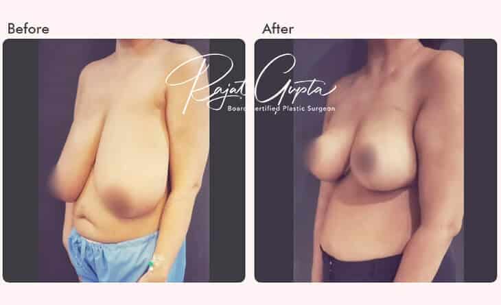 Breast Reduction Surgery Before and After- RG Flap Technique Surgery - Dr Rajat Gupta - Plastic surgery specialist Delhi - RG Aesthetics