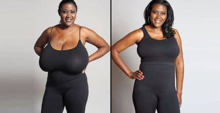 Breast Reduction Surgery- RG Flap Technique Surgery - Dr Rajat Gupta - Plastic surgery specialist Delhi - RG Aesthetics