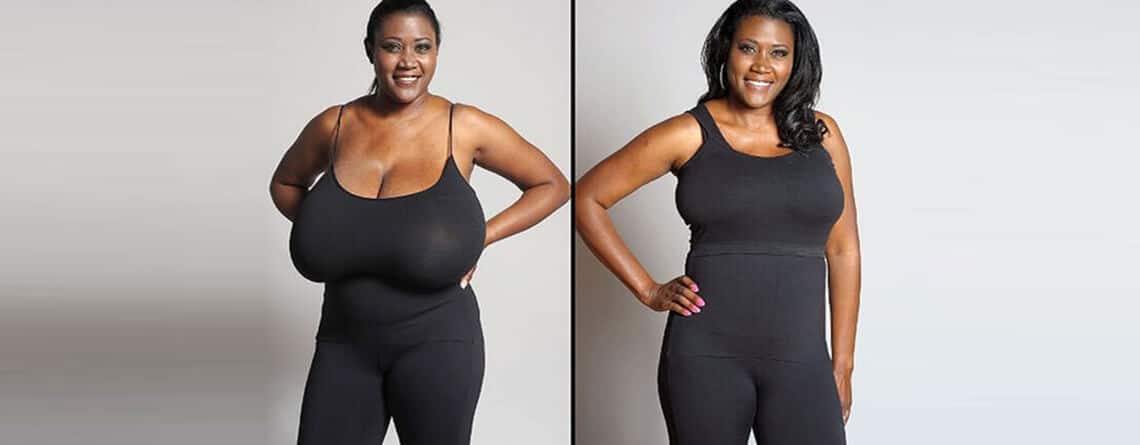 Breast Reduction Surgery- RG Flap Technique Surgery - Dr Rajat Gupta - Plastic surgery specialist Delhi - RG Aesthetics