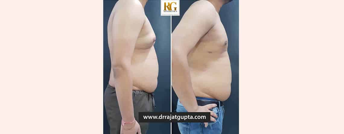How is Scarless Gynecomastia Surgery Possible in India By Dr Rajat Gupta Plastic Surgeon - RG Aesthetics