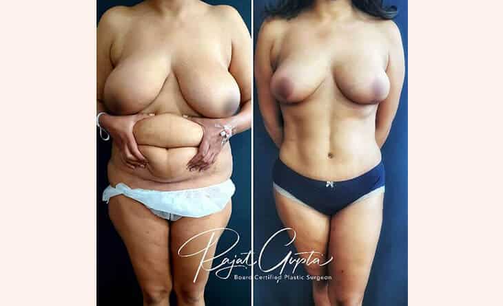 Lipoabdominoplasty Before After Results - High-Definition Abdominoplasty- RG Aesthetics