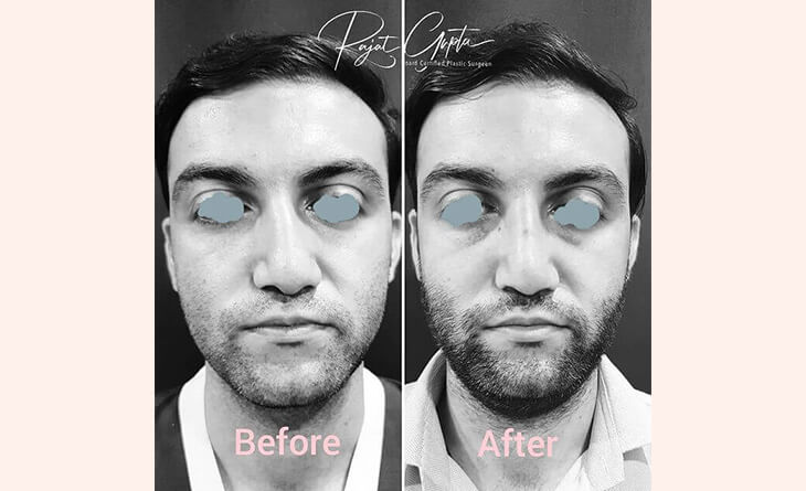 nose job surgery before and after