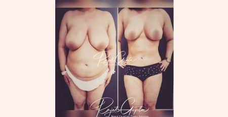 Breast Reduction Surgery Before and After