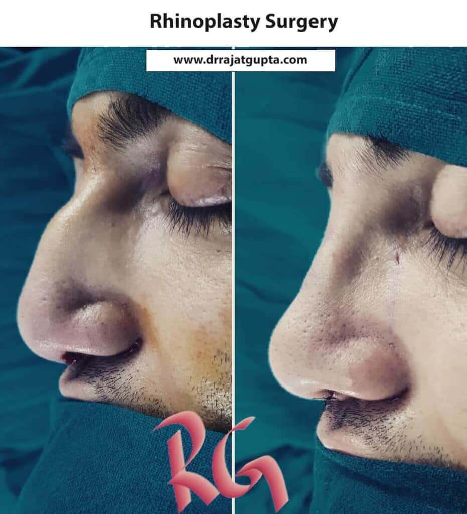 Rhinoplasty Surgery Before and After