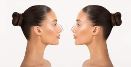 Rhinoplasty Surgery in Delhi
