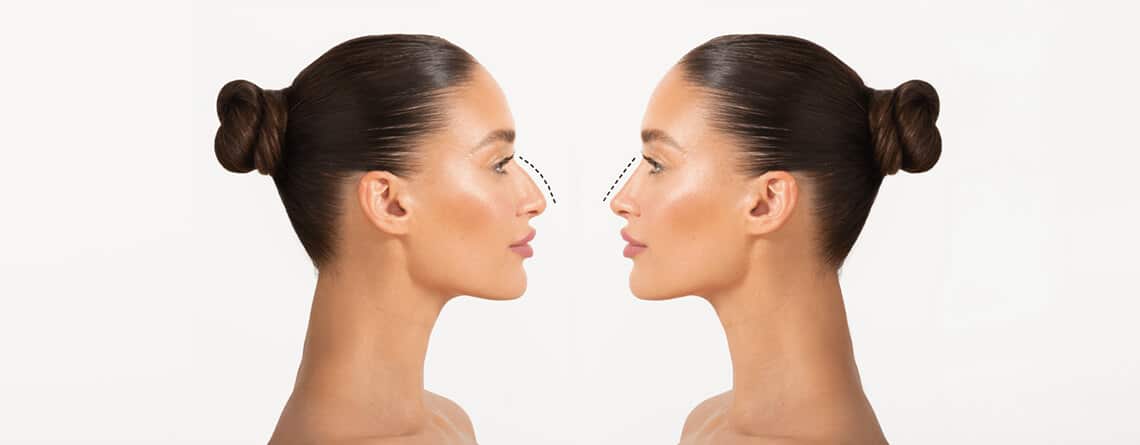 Rhinoplasty Surgery in Delhi