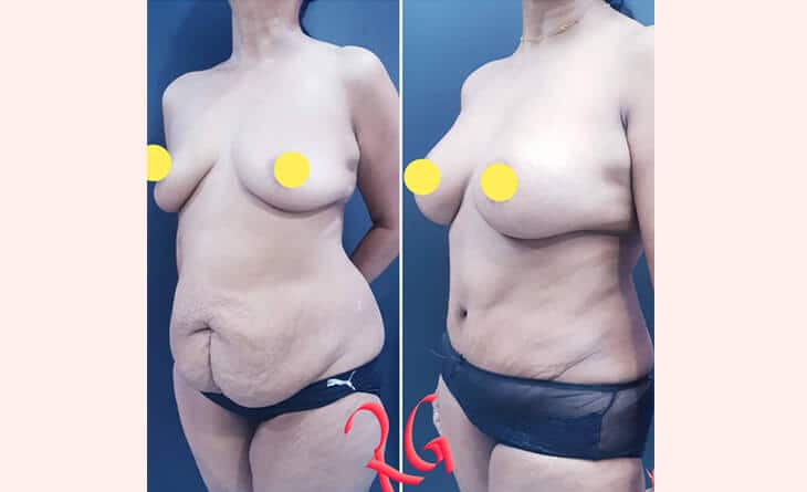 Tummy Tuck Before After Results - High-Definition Abdominoplasty- Dr Rajat Gupta - RG Aesthetics