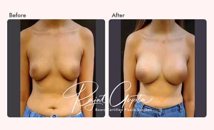 Breast Augmentation Surgery Financing Options in India - Breast Augmentation Results - Dr Rajat Gupta