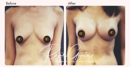 Breast Augmentation Surgery Financing Options in India - Dr Rajat Gupta - Plastic Surgeon in India