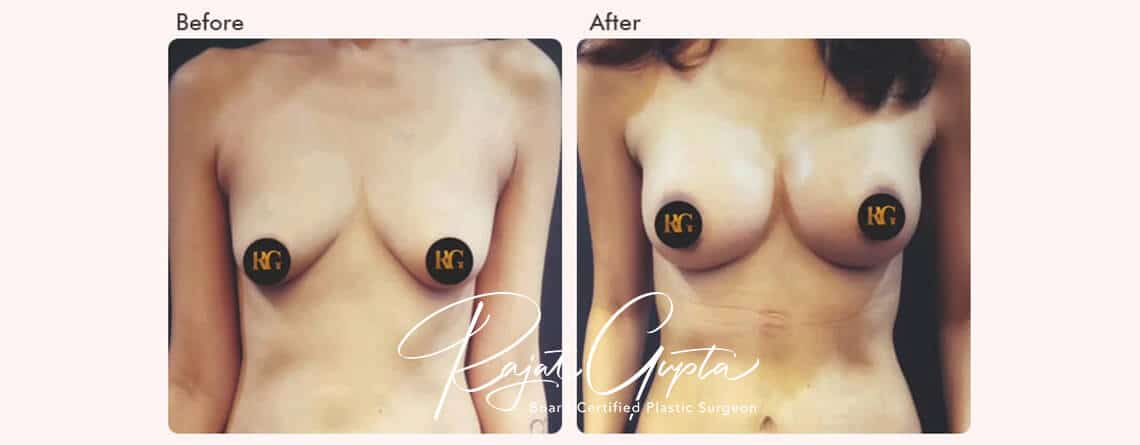 Breast Augmentation Surgery Financing Options in India - Dr Rajat Gupta - Plastic Surgeon in India
