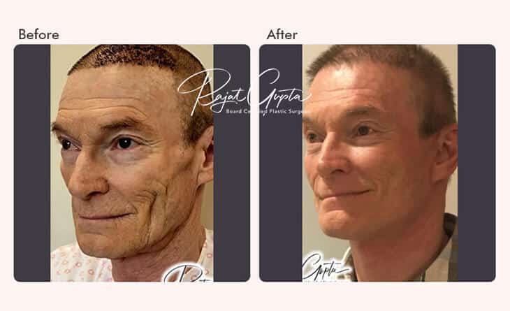 Facelift Surgery Before and After - Facelift Surgery in Delhi - Dr Rajat Gupta - Plastic Surgeon in Delhi