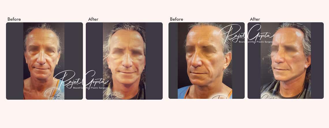 Facelift Surgery in Delhi India - Facelift Surgery Clinic in India - Dr Rajat Gupta - Plastic Surgeon in Delhi
