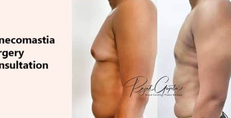 Gynecomastia Surgery Consultation - Gynecomastia Surgery in Delhi - Dr Rajat Gupta