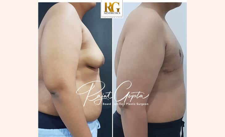 Gynecomastia Surgery Consultation - Gynecomastia Surgery in Delhi - Dr Rajat Gupta - RG Aesthetics