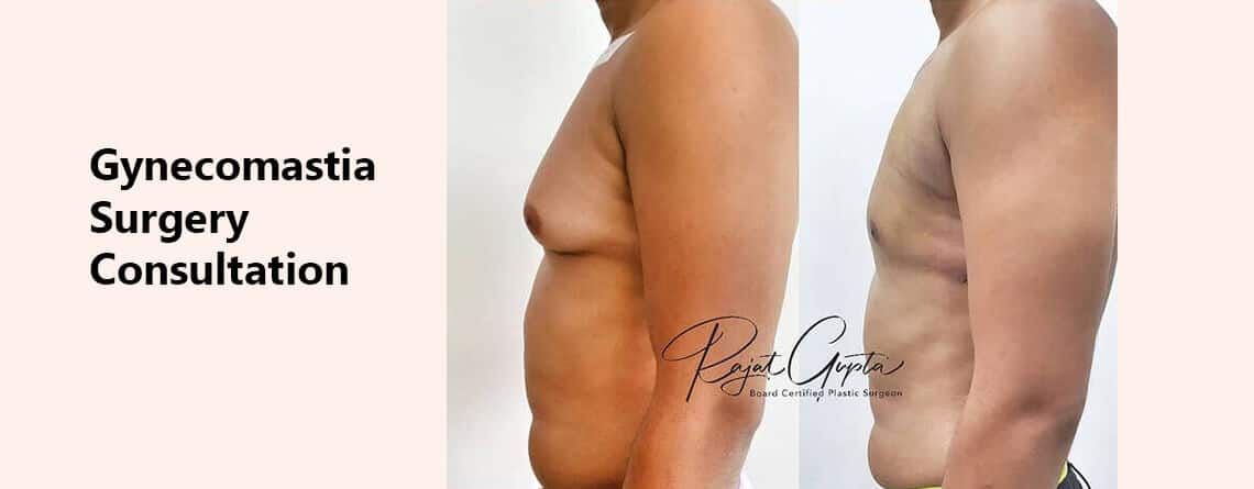 Gynecomastia Surgery Consultation - Gynecomastia Surgery in Delhi - Dr Rajat Gupta