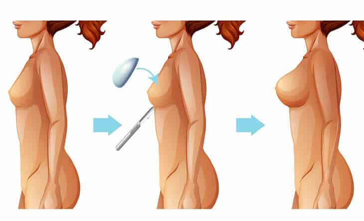 Is Breast Reconstruction Surgery Worth It - Dr Rajat Gupta - Plastic Surgeon in Delhi - RG Aesthetics