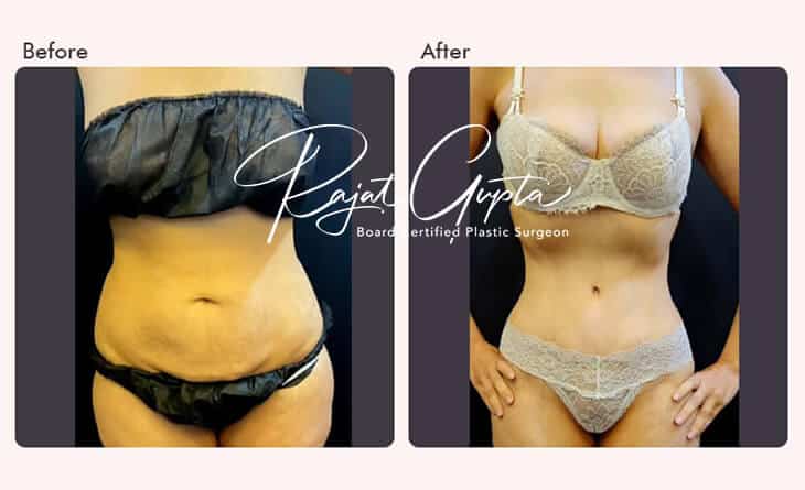 Latest Tummy Tuck Surgery Techniques - Dr Rajat Gupta - Plastic Surgeon in Delhi - RG Aesthetics