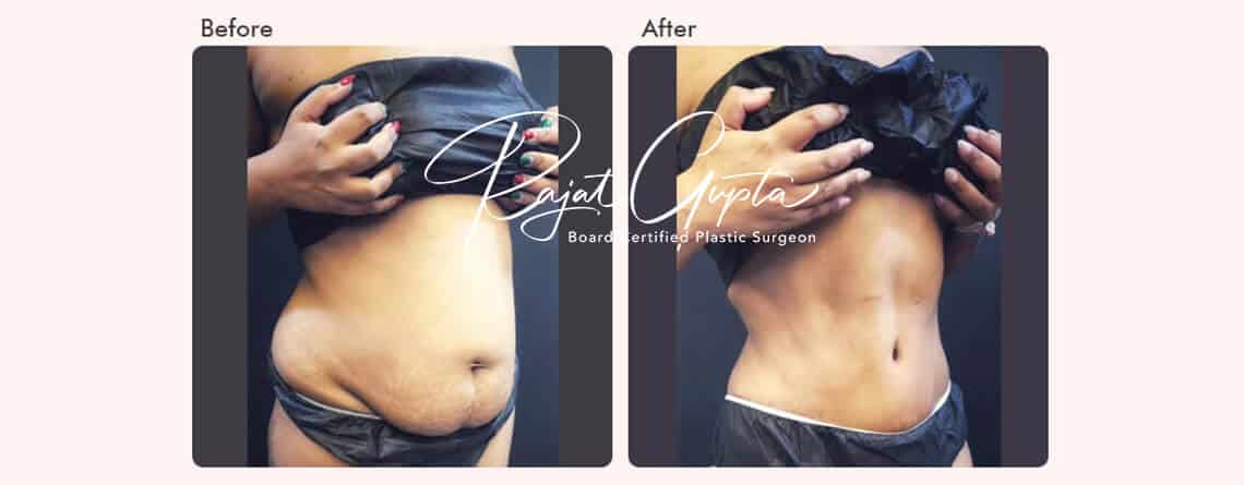 Latest Tummy Tuck Surgery Techniques - Dr Rajat Gupta - Plastic Surgeon in Delhi
