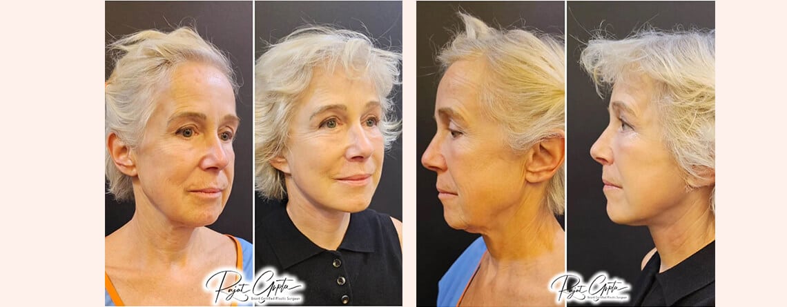 Schedule Facelift Surgery Consultation - Facelift surgery before and after - Dr Rajat Gupta - Plastic Surgeon in Delhi
