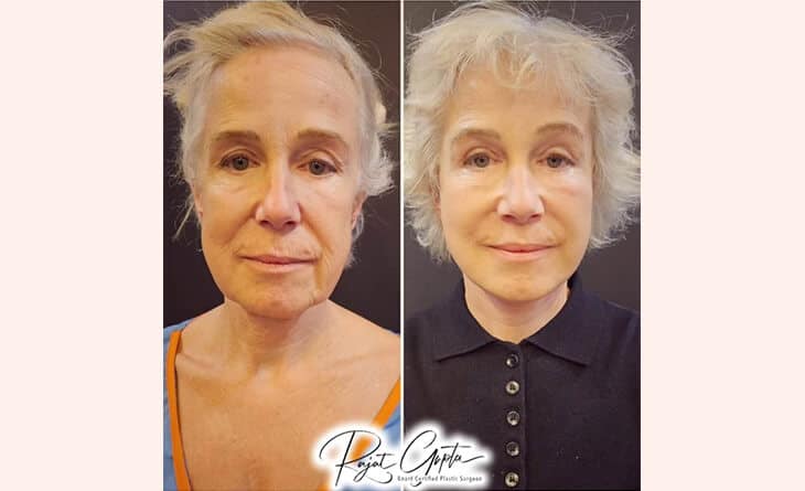 Schedule Facelift Surgery Consultation - Facelift surgery before and after - Dr Rajat Gupta