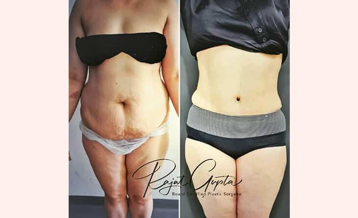 Virtual Consultations for Tummy Tuck Surgery - Tummy Tuck Results - Dr Rajat Gupta - Plastic Surgeon in India - 01