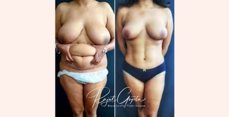 Virtual Consultations for Tummy Tuck Surgery - Tummy Tuck Results - Dr Rajat Gupta - Plastic Surgeon in India