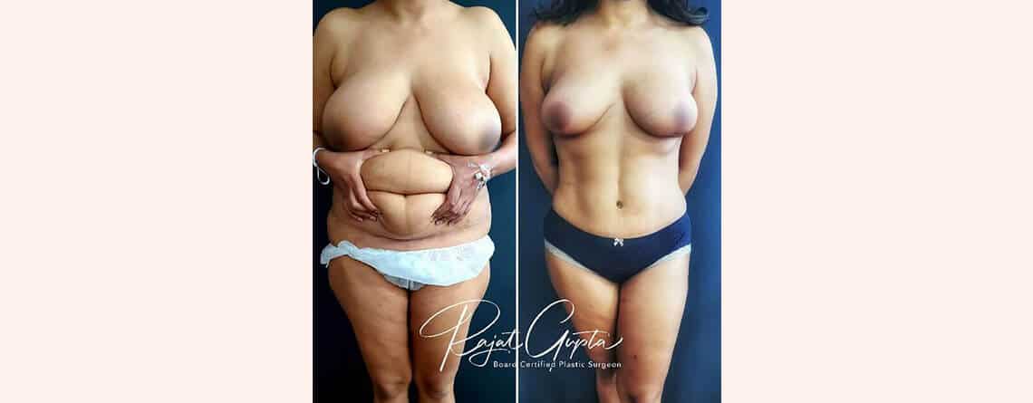 Virtual Consultations for Tummy Tuck Surgery - Tummy Tuck Results - Dr Rajat Gupta - Plastic Surgeon in India