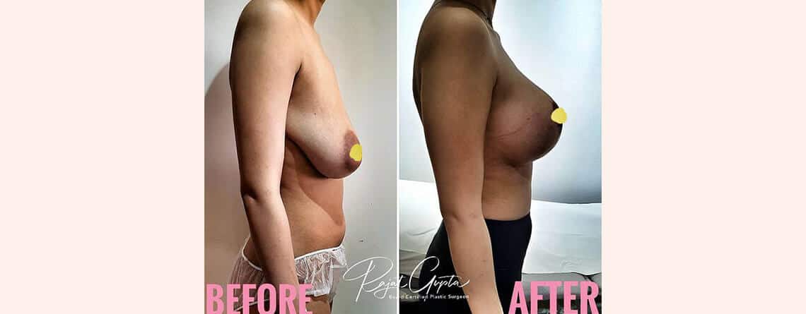 Breast Lift in Delhi