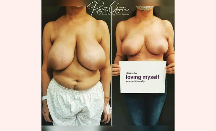 Breast Lift surgery before and after