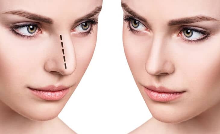 Rhinoplasty Surgery in Delhi