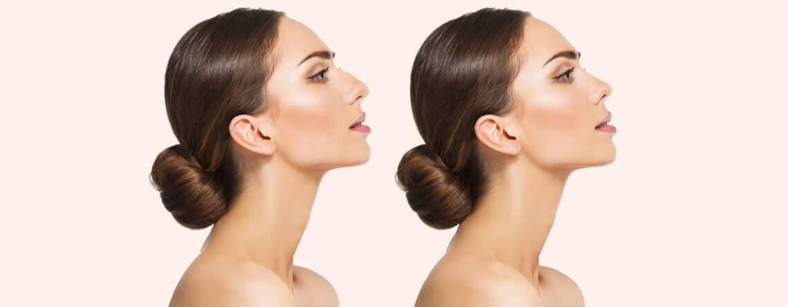 How Long Does a Nose Job Take to Heal - Rhinoplasty Surgery in Delhi