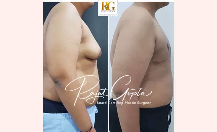 Gynecomastia Surgery Before and After