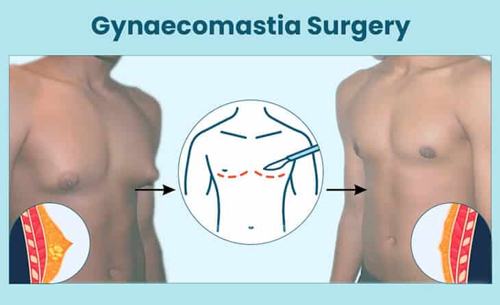 Gynecomastia Procedure in Delhi