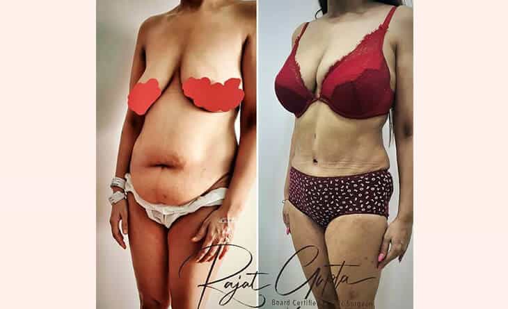 Liposuction Surgery Before and After - Liposuction Surgery Cost in Delhi - Dr Rajat Gupta
