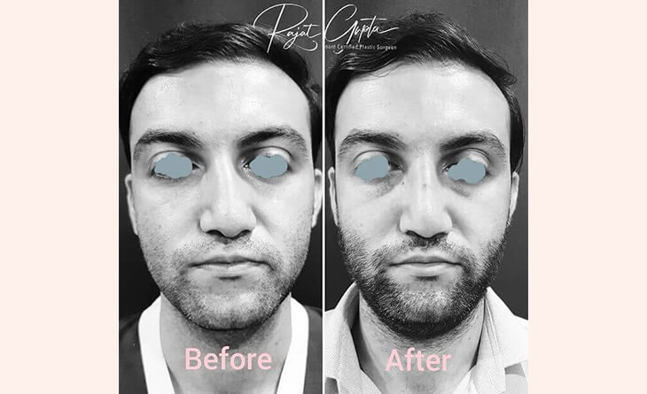 Rhinoplasty Surgery Before and After