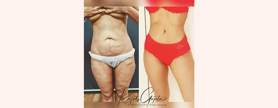 Tummy Tuck Surgery before and after