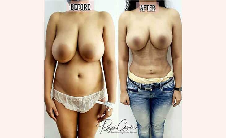 Breast Reduction Surgery Before and after