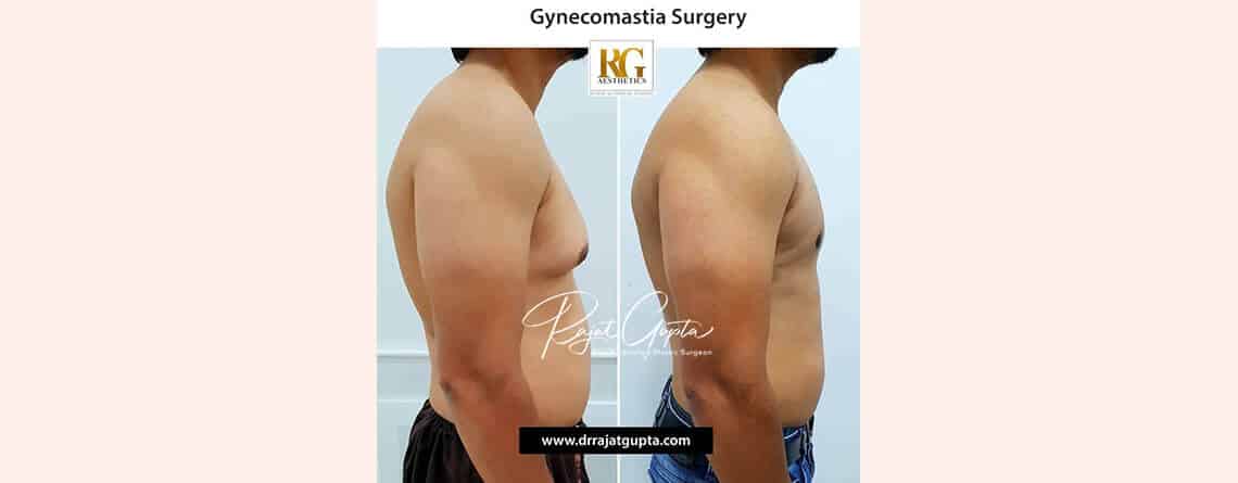 Is Gynecomastia a Big Surgery