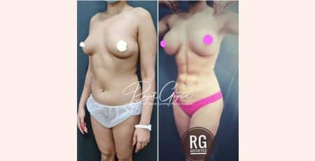 Liposuction Surgery in Delhi