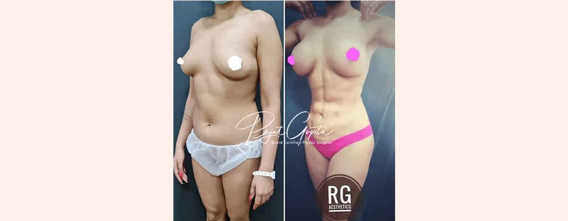 Liposuction Surgery in Delhi