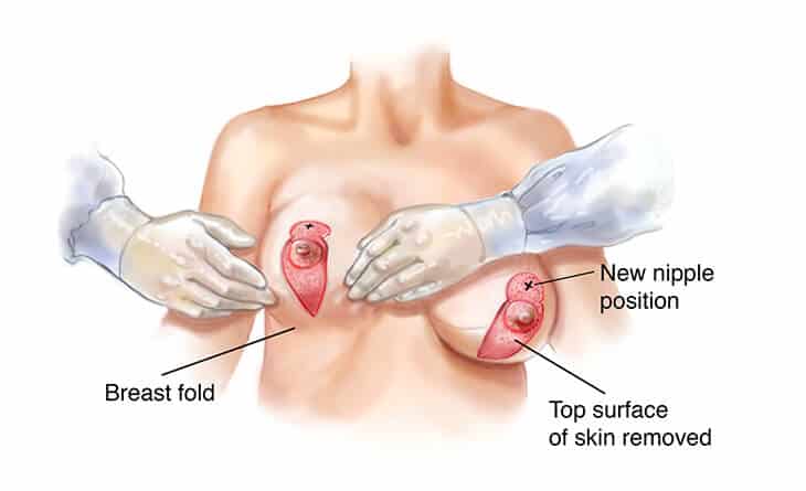 Breast Lift Surgery Techniques