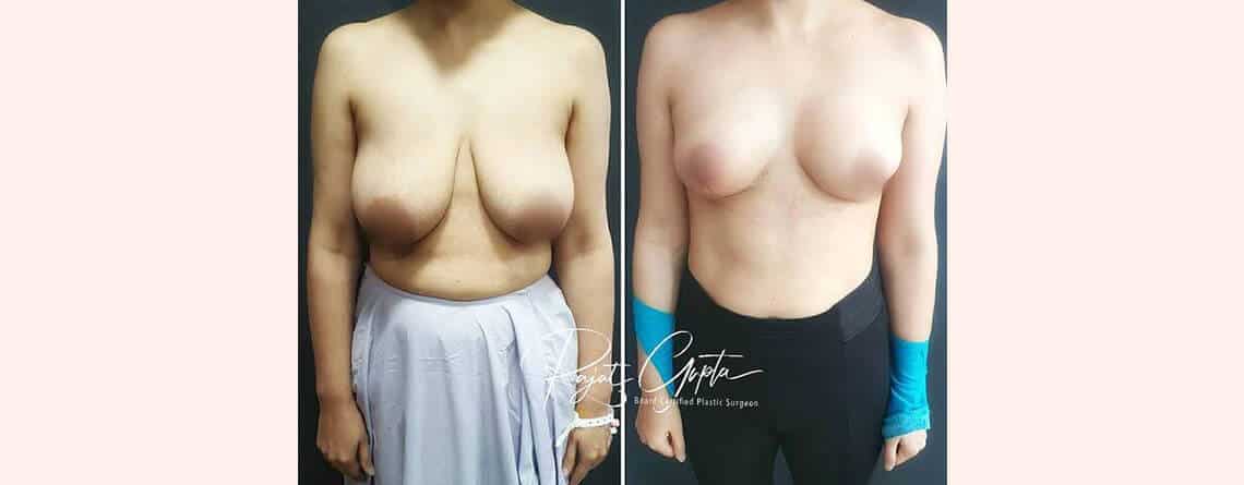 Breast Lift Surgery in Delhi