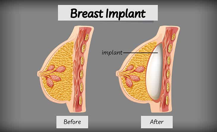 Breast Augmentation in Delhi