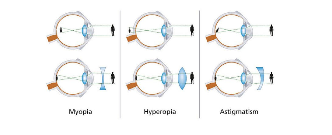 myopia lense
